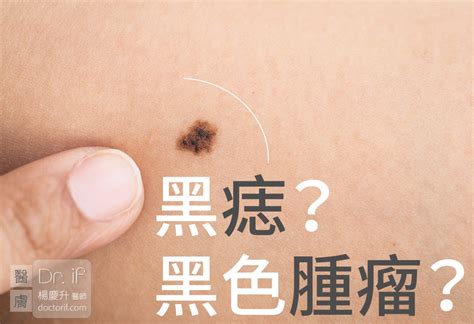 生黑痣|不大驚小怪！如何辨別「黑痣」與「黑色腫瘤」？ 